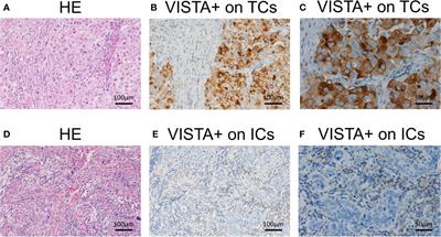 VISTA Expression on Immune Cells Correlates With Favorable Prognosis in Patients With Triple-Negative Breast Cancer